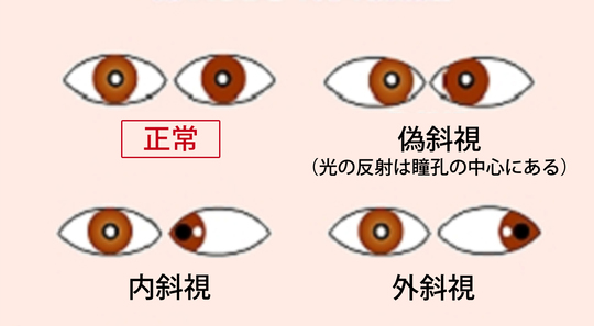 斜視 内 斜視を治すにはどのようなトレーニングをするべきか？｜シリモノ